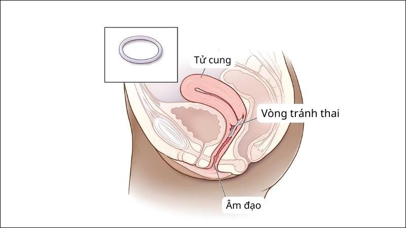 17 biện pháp tránh thai an toàn, hiệu quả và phổ biến hiện nay