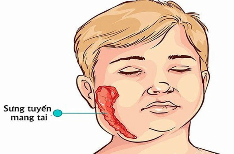 Một số cách chữa quai bị bằng mật ong và lưu ý khi thực hiện