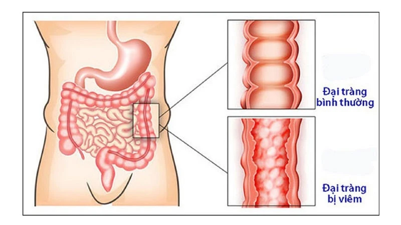 Đau bụng dưới ở nam giới - những vấn đề cần lưu tâm